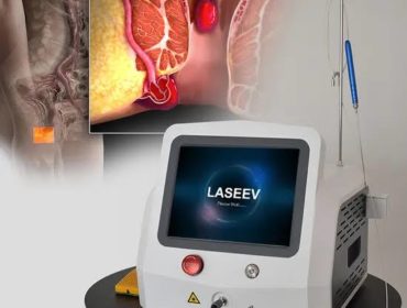 Hémorroïdes laser